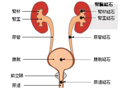 症状 結石 尿 路 【医師監修】尿路結石になるとどんな症状が出てくる？再発しやすいって本当？